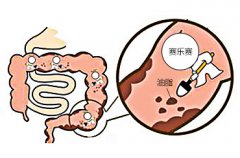 赛乐赛减肥药是怎样减肥的？会不会让人厌食？